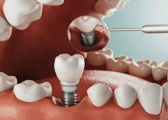 What Makes Dental Implants In Essex Trustworthy
